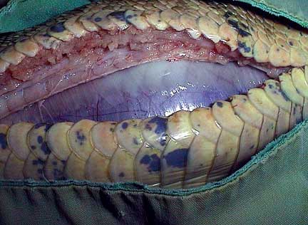 Impacted intestine during surgery