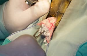 Stone fragments visible in the opening of the urinary bladder