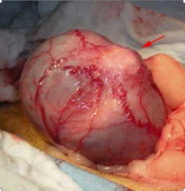 Cancerous bladder during surgery