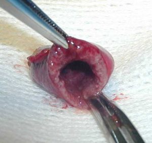 Inside of thickened gallbladder