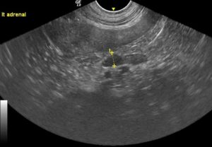 Ultrasound of adrenal gland