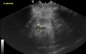 Ultrasound of left adrenal gland