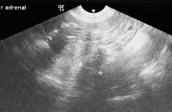 Ultrasound of an adrenal gland