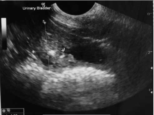 Ultrasound of bladder cancer