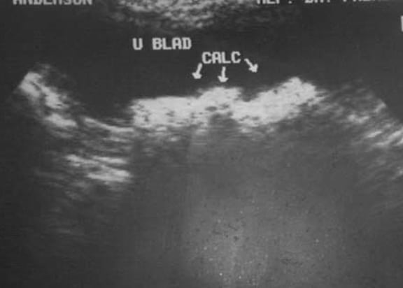 Ultrasound of bladder stones