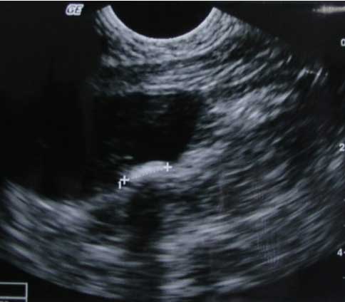 Ultrasound of large bladder stone