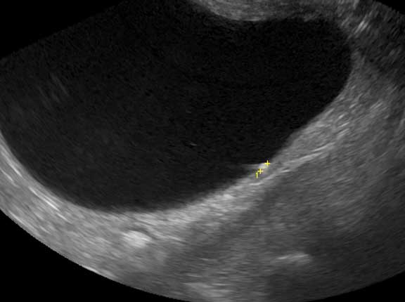 Ultrasound of small bladder stone