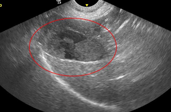 Ultrasound of gallbladder