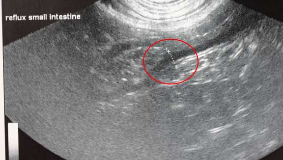 Ultrasound showing ulcer in small intestines
