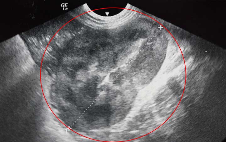 Ultrasound of kidney showing cancer