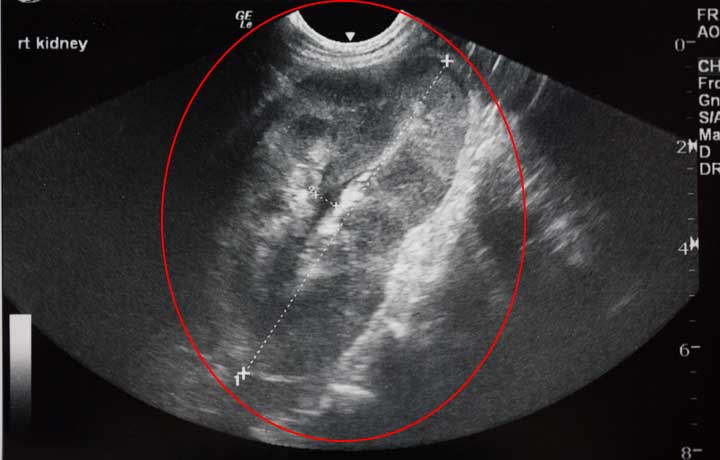 Ultrasound of kidney showing cancer