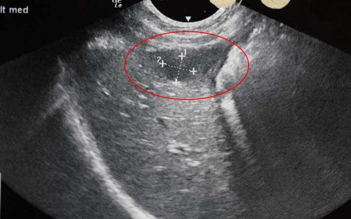 Ultrasound of cyst in liver