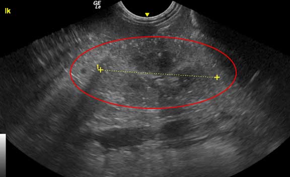 Ultrasound of glomerulonephritis