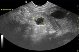 Ultrasound of a lymph node