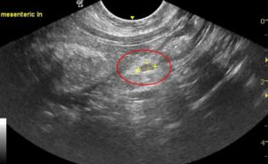 Lymph node during ultrasound