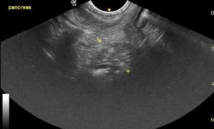 Ultrasound of the pancreas