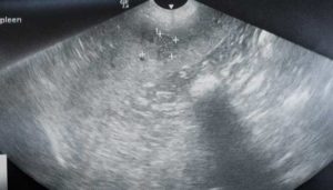Ultrasound showing spleen nodule