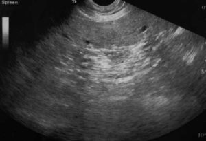 Spleen ultrasound