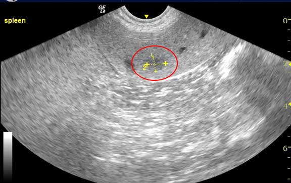 Ultrasound of splenic nodule