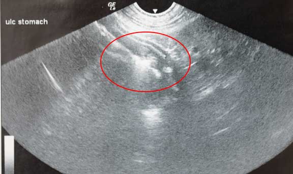 Ultrasound showing ulcer in stomach