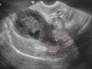 Ultrasound of large bile duct