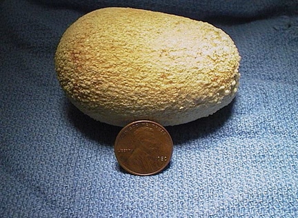 Large bladder stone