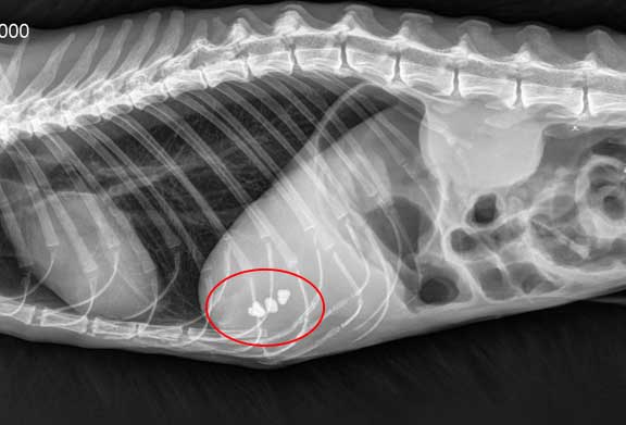 x-ray of gallstones