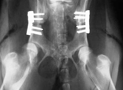 Xray of plate and screws put in a pelvis