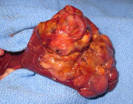 Cancerous ferret liver lobe.