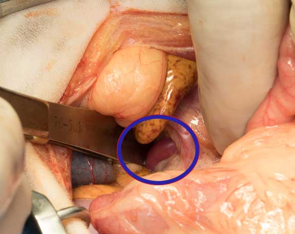 Enlarged common bile duct