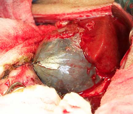 Enlarged gall bladder during surgery
