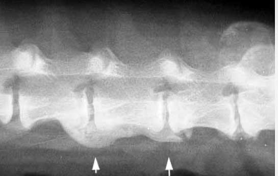 Arthritis of the spine called spondylosis.