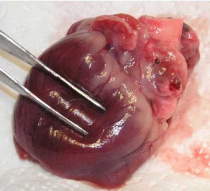 A heart with dilated cardiomyopathy showing the flabby ventricle.