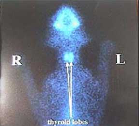 Feline thyroid scan.