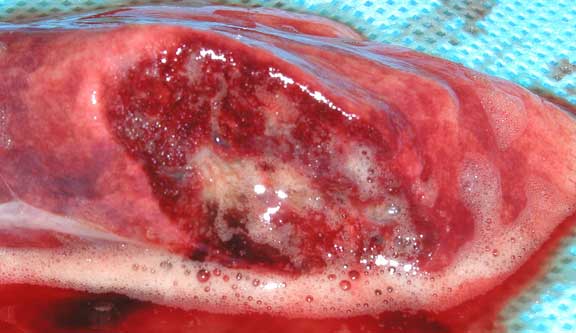Necropsy picture of a section of the lung with pulmonary edema